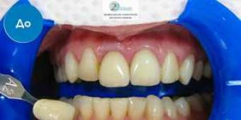 Отбеливание зубов - как это делается Что такое отбеливание зубов в стоматологии