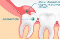 Причины роста кривых зубов