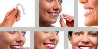 Сколько стоит отбеливание зубов в стоматологии