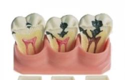 Лечение кариеса зуба: этапы и фото Кто ставит пломбы на зубы какой врач
